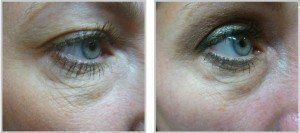 Before and after of lower eye using skintyte treatment