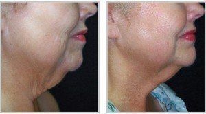 Before and after of a woman's neck skintyte treatment