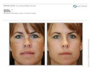 Woman's face before and after BBL treatment