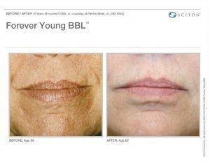 Woman's mouth before and after of Forever Young BBL treatment
