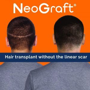 NeoGraft: Hair Transplant without the linear scar