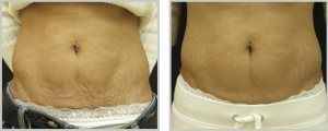 Before and after of a womans stomach skintyte treatment