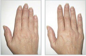 Before and after of a woman's hand skintyte treatment