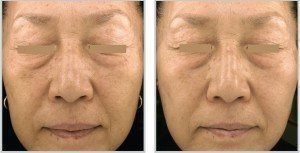 Before and after of a woman's face skintyte treatment