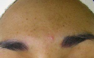 Skin damage from sun and acne before