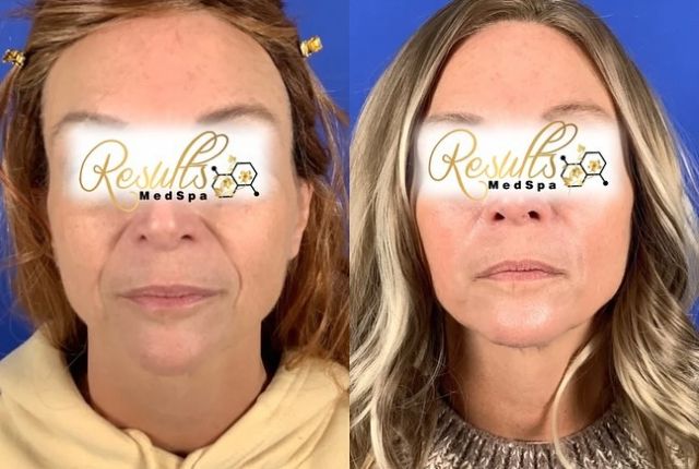 Amazing before and after of dermal filler in the cheeks and nasolabial folds! Such an incredible difference😍

#dermalfiller #injectablefillers #ctmedspa #ctplasticsurgeon #glow #facemaskrejuvenation