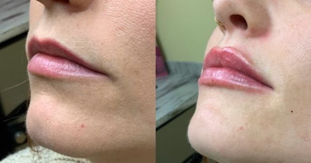 Have that pretty pout just in time for Valentine’s Day💋 Subtle enhancement to these lippies made all the difference for this client! This before & after is immediately after the treatment! 
 

#lipfiller #galderma #kysselips #ctmedspa #aestheticnurse #nurseinjector #plasticsurgeon #ctplasticsurgeon #medspa #valentines #girls #glow #lips #prettypout