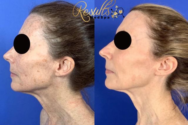 Amazing results with our broad band light treatments to clean up sun damage! Can’t get enough of these results with this treatment!! Minimal downtime, and effectiveness with every treatment. This is over the course of a year’s work of progress with these treatments! Dedication = Results 

#BBL #sundamage #laser #sciton #laserseason #ctmedspa #plasticsurgeons