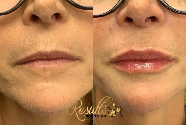 Starting off the week right with some versa lips😍 Subtle volume and hydration added with this beautiful product! 

#lips #filler #lipfiller #plasticsurgeons #ctmedspa #natural #naturalbeauty #prettypout #injector #versalips💋💋