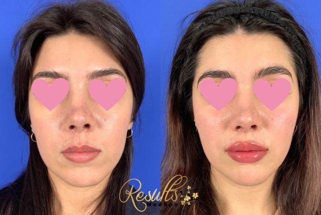 Filler in the cheeks, chin, and lips for this beauty. Facial balancing is important with dermal filler!😍 

#filler #dermalfiller #ctmedspa #nurseinjector #plasticsurgeon #ctplasticsurgeon #injectables