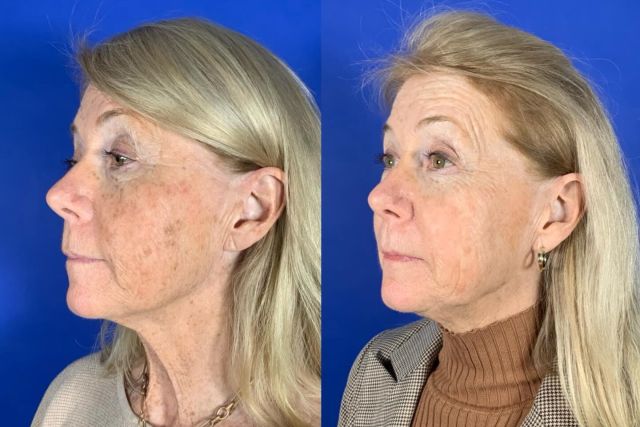 Amazing transformation with our BBL technology to target sun damage, broken capillaries, and Rosacea. This result is after two treatments. Absolutely incredible! Get in before summer starts to tackle your sun damage! Take advantage of our laser sale until end of April! 

#scitonbblhero #bbl #ctmedspa #ctplasticsurgeon #glow #sundamage #skintone #beforeandafter