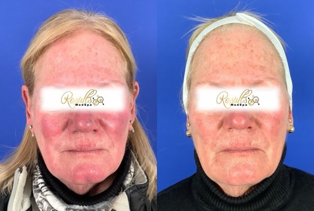 The power of @platedskinscience for redness is a miracle! This patient used Plated intense consistently for 4 weeks straight, and had incredible results! We also spot treated some of her veins with the clear v laser. We are continuing treatment with our lasers to further benefit this patients results! 

#plated #exosome #regenerativemedicine #platelets #scitonclearv #veins #befoerandafter #ctmedspa