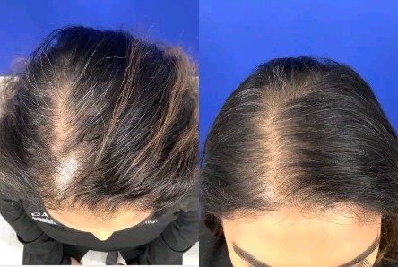 The early results are in!! This is our nurse Liz's @platedhairscience 3 month result using the drops 1-2x/day. She's seeing much less shedding, faster hair growth, and new little baby hairs filling in the bald spots. This is the fastest results we've seen for topical hair restoration even compared to Rogaine. ✨🤩 RUN, don't walk and get your hands on this revolutionary product 👏