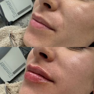 Lips like sugar💋🍭 This patient already had the prettiest lips we just emphasized and defined her features! These after photos are fresh off the syringe! 

#lipfiller #kiss #restalynekysse #galderma #lipgoals💋