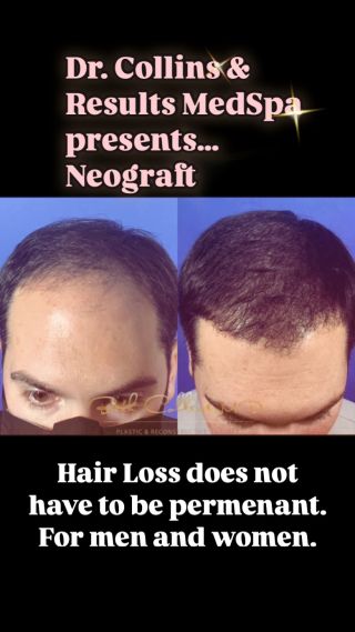 Dr. Collins and Results MedSpa is offering the Neograft Hair Transplant procedure at both our locations.  This is State of the Art hair transplant for men and women who suffer from hair loss. The results are natural and remarkable.  Book a consultation by calling us at (203) 689-5295.

#ctmedspa #neograft #neografthairtransplant #hairlosssolution #hairloss