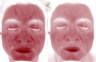 Our VISIA camera technology analyzes the skin on a surface and subsurface level. This before and after is post 2 Moxi laser treatments. You can see in the first picture the improvement of pigmentation and redness. The patient is left with a polished skin appearance on the surface level, and less inflammation on the subsurface level. The last image shows how the brown pigmentation as improved between pre treatment and post two treatments. We are completing a series of three treatments for this patient. With this VISIA skin analysis, we are able to accurately track her progress with the laser on multiple depths. The results are amazing. 

#moxi #laserseason #sciton #ctmedpsa #ctplasticsurgeons #plasticsurgeon #laser #visiaskinanalysis #visia #beforeandafter