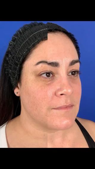 We are deep into laser season and are so excited to share happy patient results. This patient had her first @sciton_inc BBL & Moxi and paired it with @platedskinscience skincare to help improve her pigment, pore size and overall skin quality. She was already gorgeous but now she is just polished and bright! 💖 We love combination therapies paired medical grade skincare!

Call or schedule online to book a consultation with our skin and laser experts at Results Medical Spa in either Mystic or Guilford locations 📍.

#ctmedspa #ctplasticsurgeon #glow #sciton #moxi #BBL #skincare #pigmentation #skin #platedskinscience