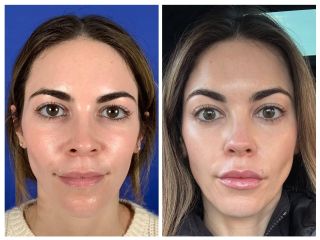 Lips can really harmonize the face! 💋 This patient had been doing lip flips with Botox for a number of years but never felt like it really achieved the look she was going for. She was nervous to take the plunge with filler but was so thrilled with the natural and more enduring results! 

This result is the perfect gift for Valentine's Day. 💕

#filler #lips #lipfiller #injector #injectables #resultsmedspa #results #medspa #aesthetics #aestheticinjector #beauty #valentineday #kiss #versalips